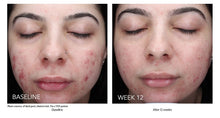 Load image into Gallery viewer, ZO® Acne Complex